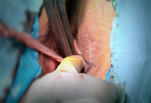 Cirugía íntima femenina