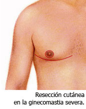Resección cutánea en la ginecomastia severa.
