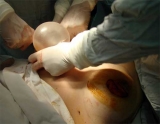 Implantes mamarios y tratamiento de cncer de mamas