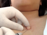 Inyecciones de Botox para las cicatrices queloides 
