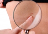 Manchas en la piel: causas, cuidados y tratamientos