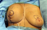 En España, el aumento de mamas es la cirugía estética de mayor demanda