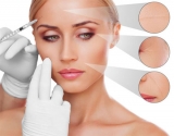 Aplicacin de PRP en rejuvenecimiento facial: preguntas y respuestas