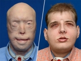 Trasplante de cara: presentan el caso más complejo