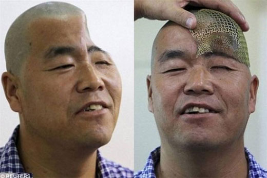 Reconstruirán el cráneo de un hombre con impresoras 3D