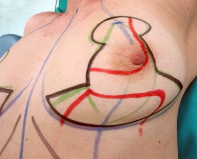 Levantamiento de mamas caídas: correcciones con relleno y remodelación